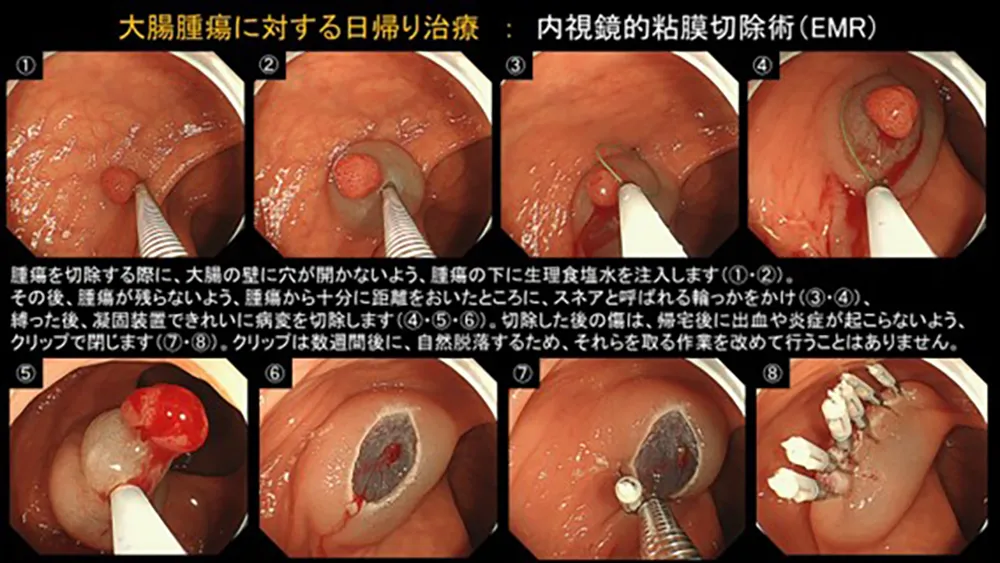 日帰り内視鏡治療の流れ